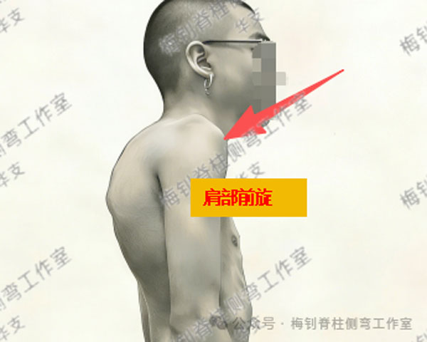 脊柱侧弯保守治疗培训班