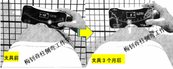 脊柱侧弯