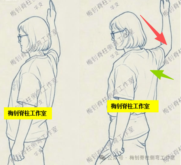脊柱侧弯知识