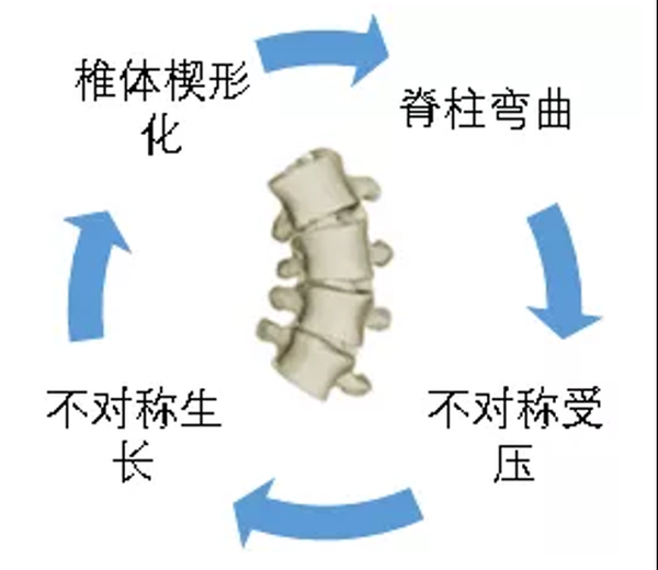 脊柱侧弯进展的恶性循环