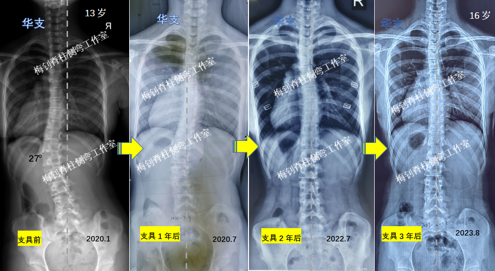 儿童脊柱侧弯