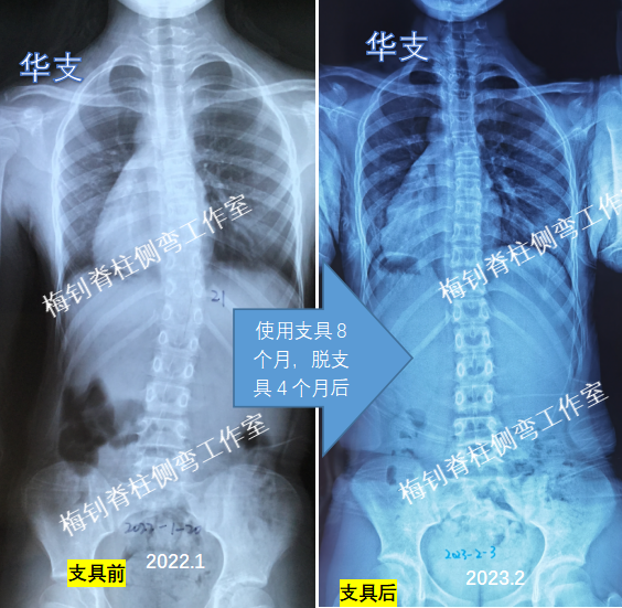 儿童脊柱侧弯矫正