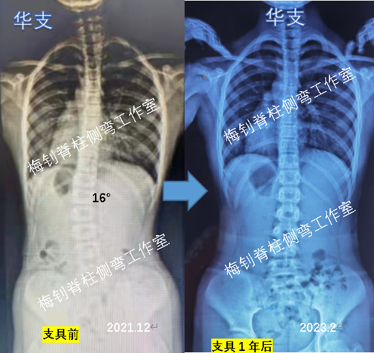 儿童脊柱侧弯