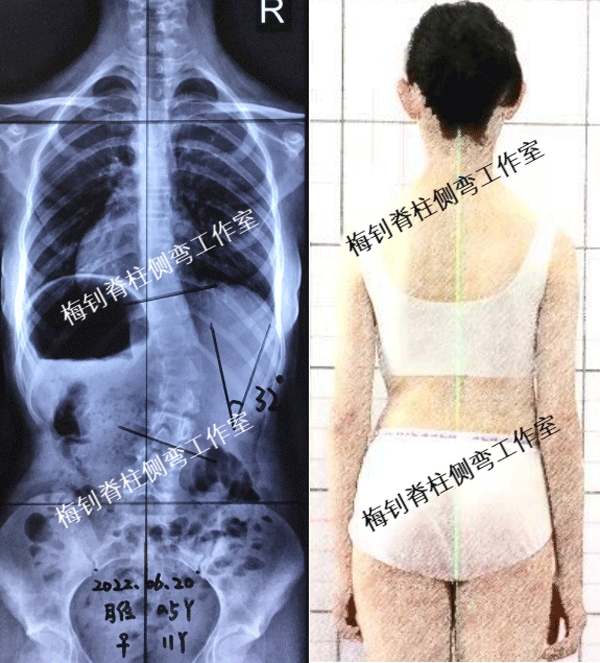 脊柱侧弯知识