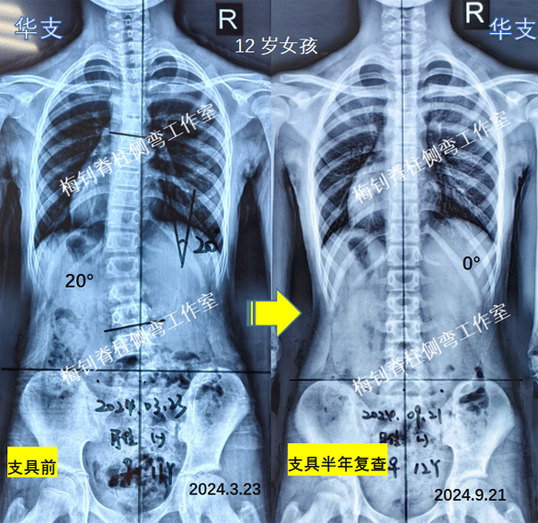 脊柱侧弯矫形器技术培训