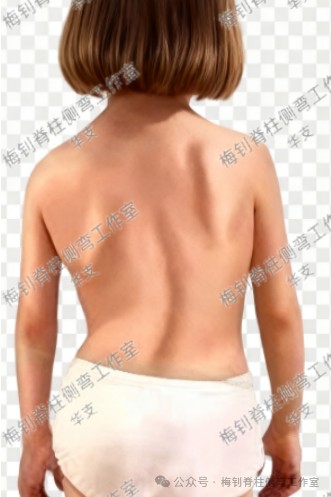 脊柱侧弯保守治疗培训班