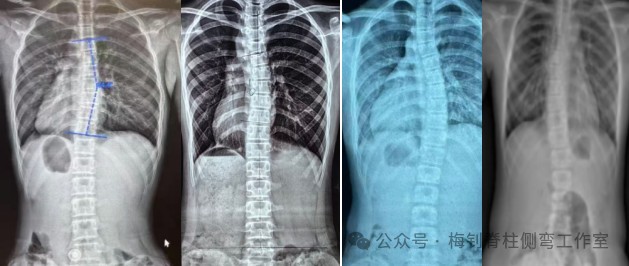 脊柱侧弯保守治疗培训班