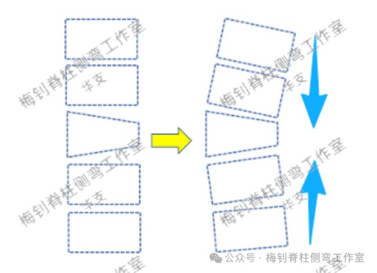 脊柱侧弯保守治疗培训班