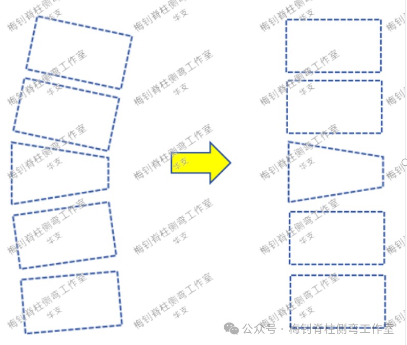 脊柱侧弯保守治疗培训班