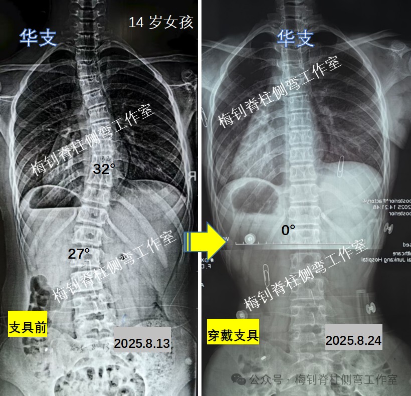 脊柱侧弯保守治疗培训班