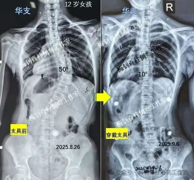脊柱侧弯保守治疗培训班