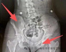 脊柱侧弯保守治疗培训班