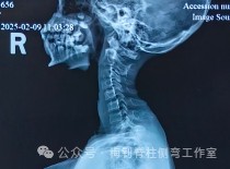 脊柱侧弯保守治疗培训班