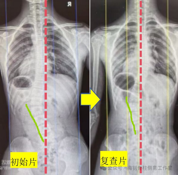 脊柱侧弯保守治疗培训班