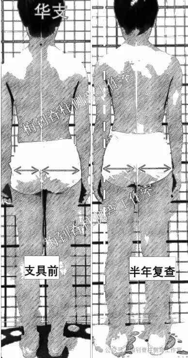 脊柱侧弯保守治疗培训班