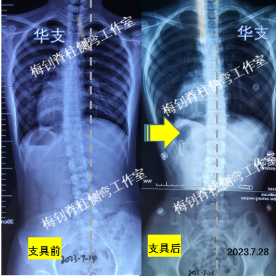 儿童脊柱侧弯